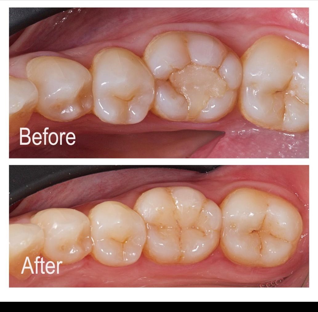 Before and after view of an esthetic composite dental restoration