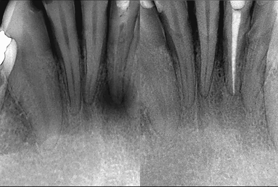 Before and after dental X-rays of a root canal treatment