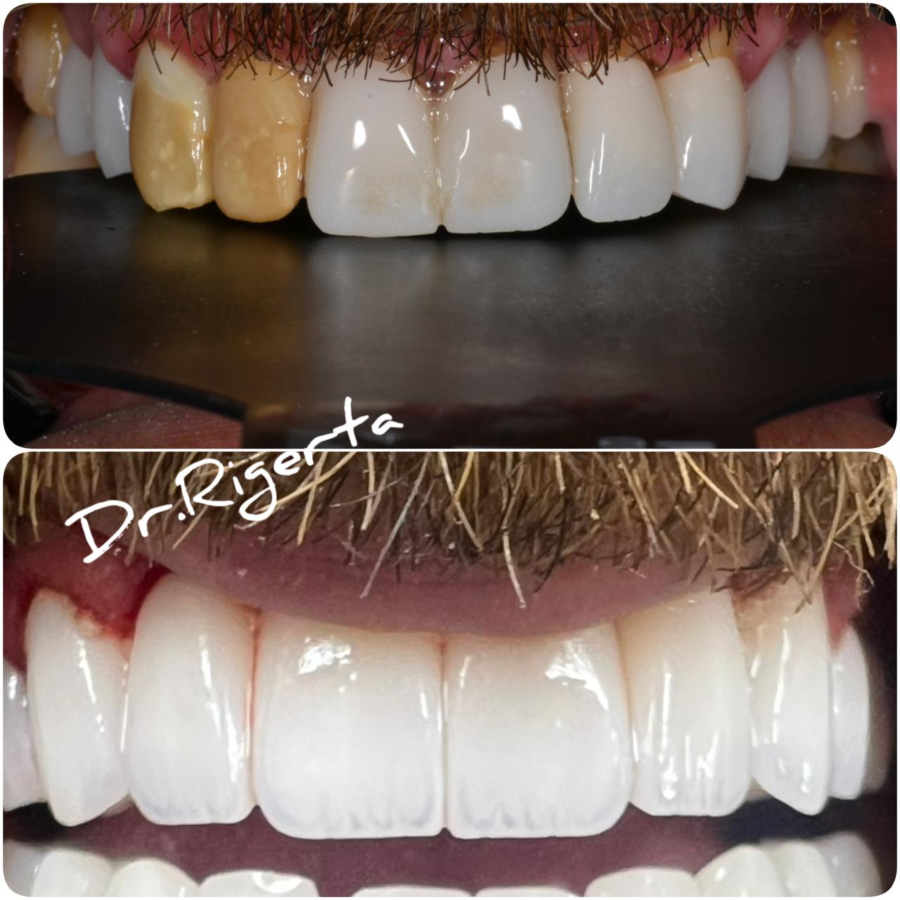 Before and after view of a veneer replacement treatment